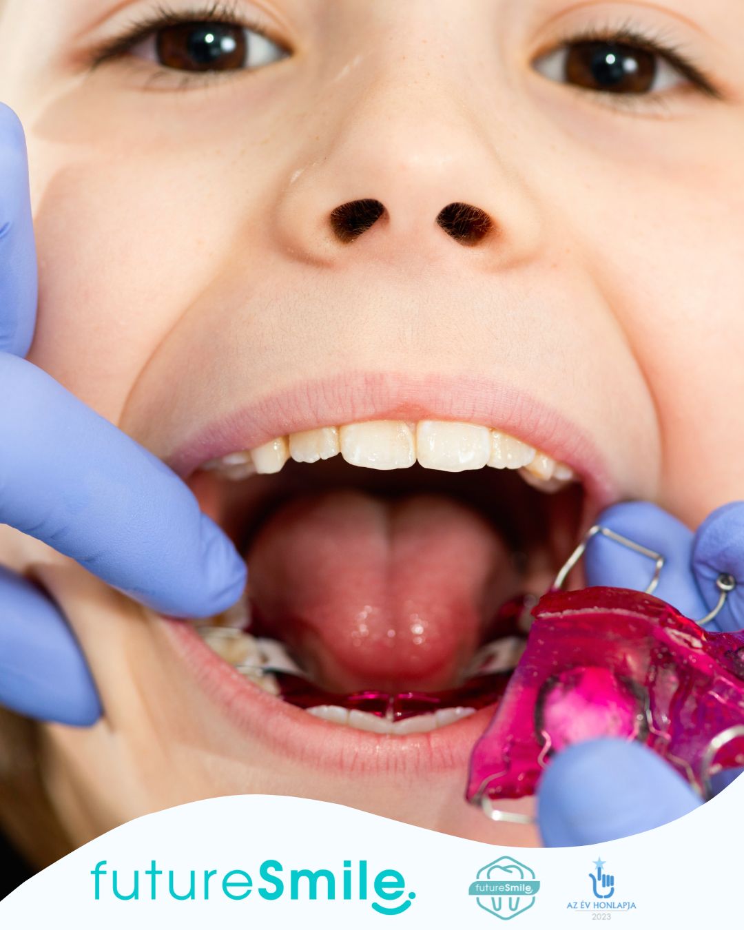 Gyerekek fogszabályzása – mikor érdemes elkezdeni?