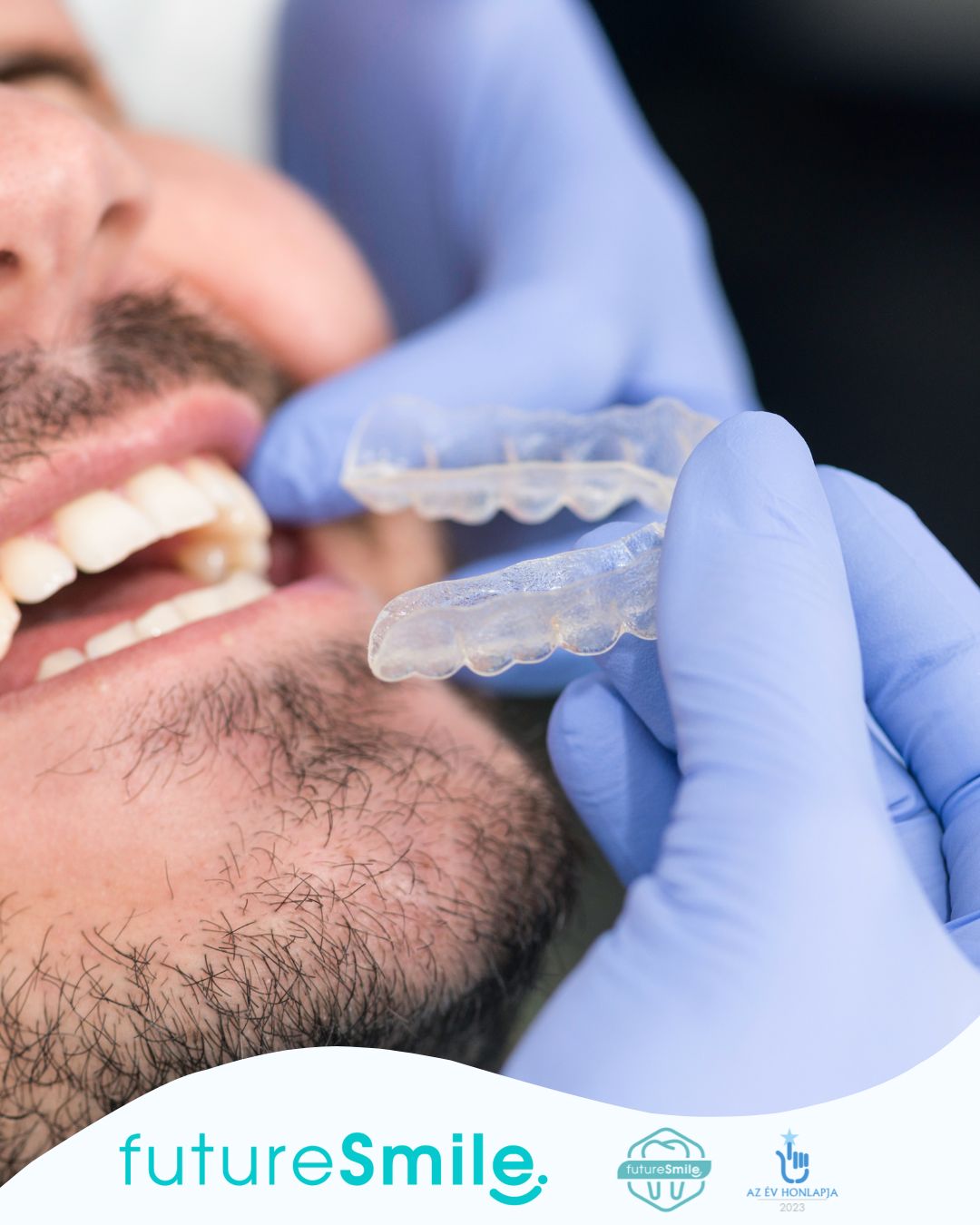 Fogszabályzó sportolóknak és aktív embereknek